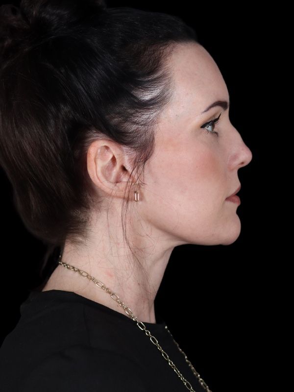 Deep Plane Facelift Gallery Before & After