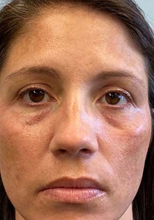 Filler Before & After