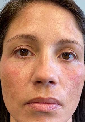 Filler Before & After