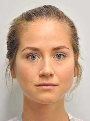 Filler Before & After