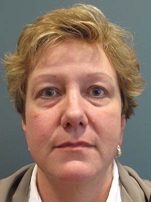 Filler Before & After