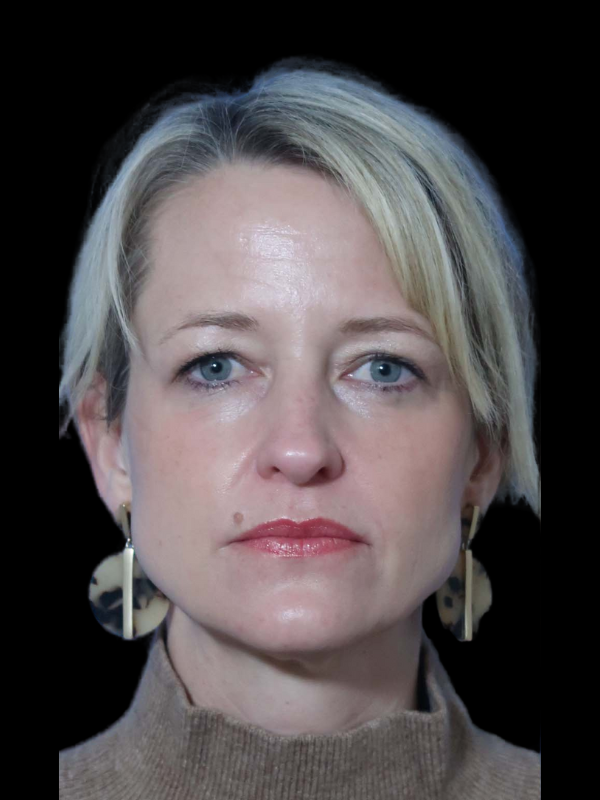 Endoscopic Browlift Gallery Before & After