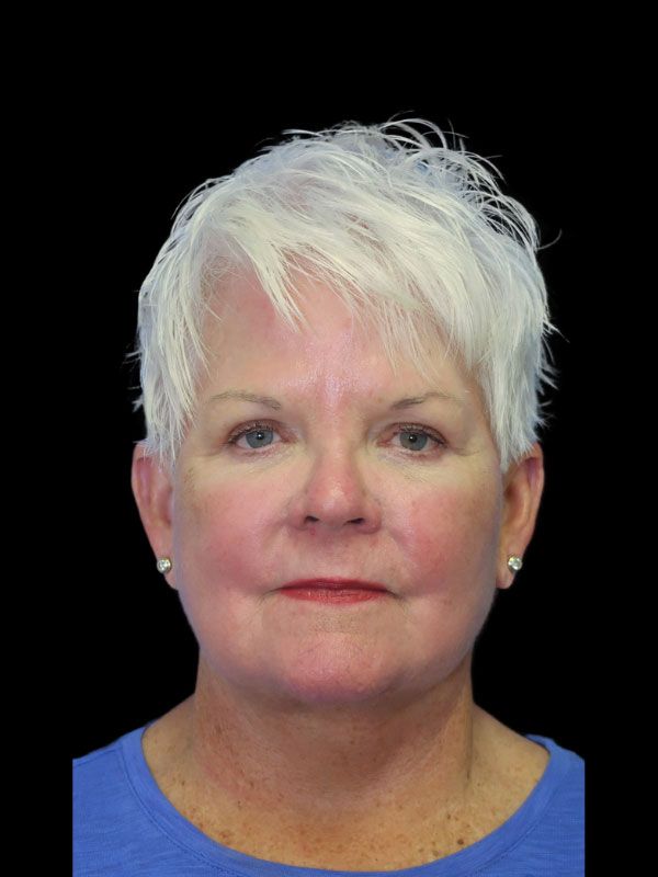 Endoscopic Browlift Gallery Before & After