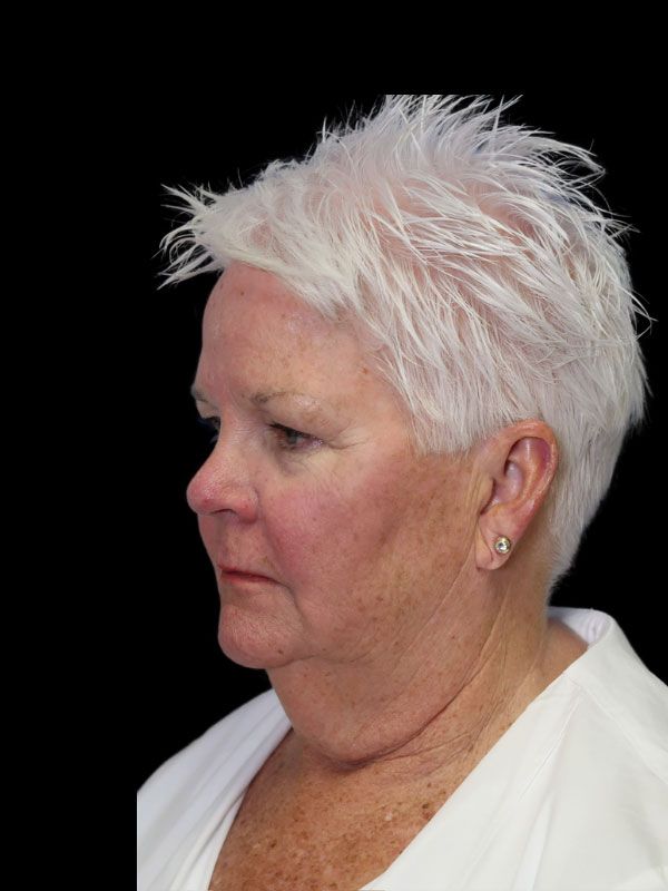 Endoscopic Browlift Gallery Before & After