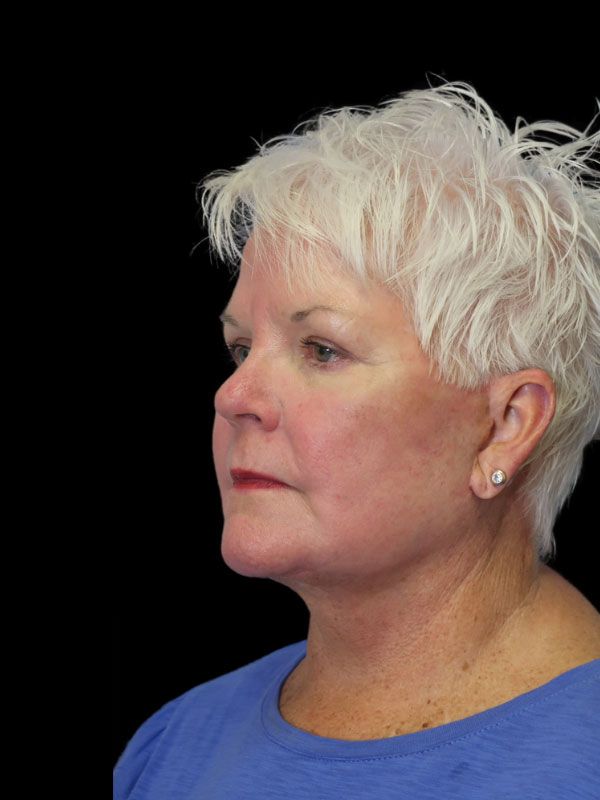 Endoscopic Browlift Gallery Before & After