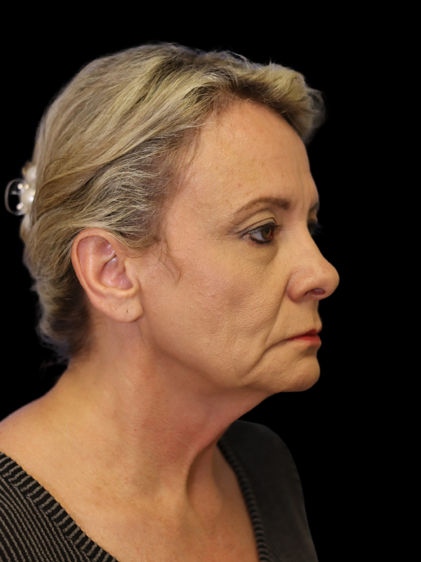 Endoscopic Browlift Gallery Before & After