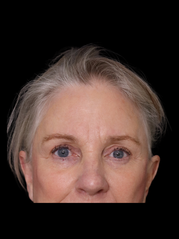 Endoscopic Browlift Gallery Before & After