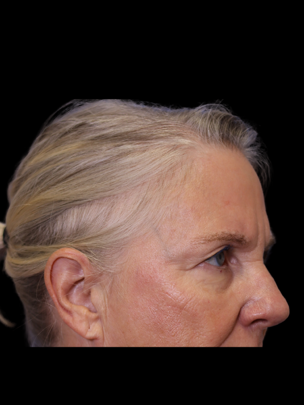 Endoscopic Browlift Gallery Before & After