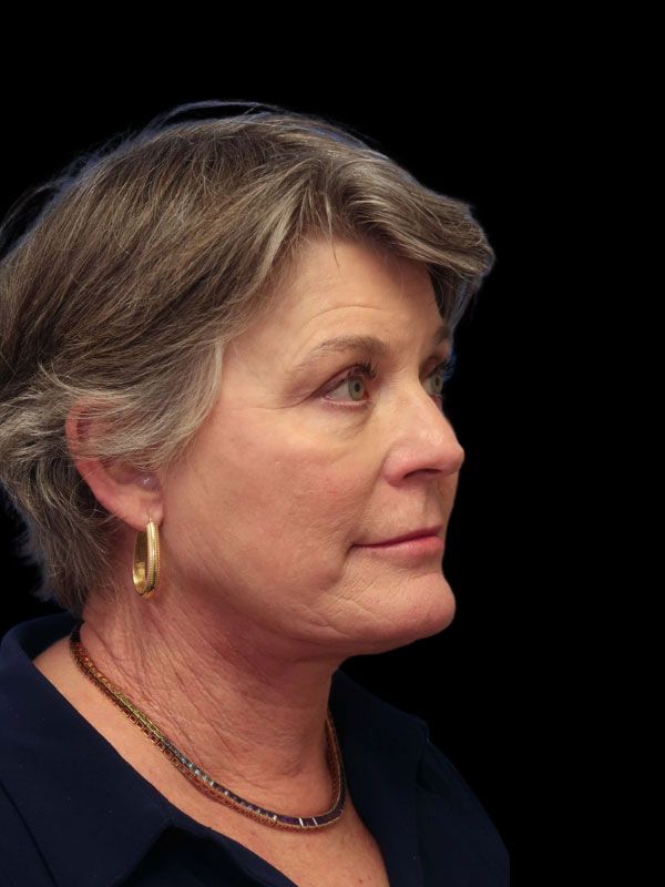 Endoscopic Browlift Gallery Before & After