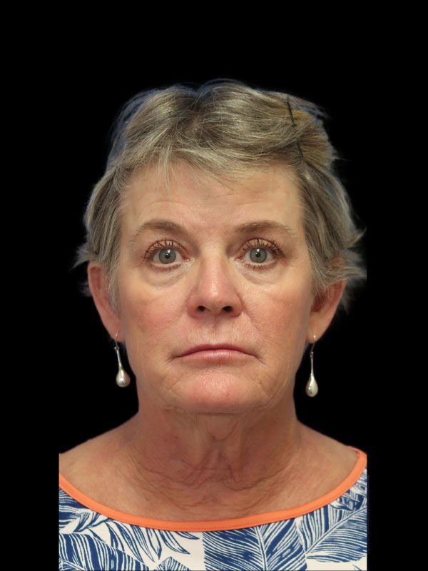 Endoscopic Browlift Gallery Before & After