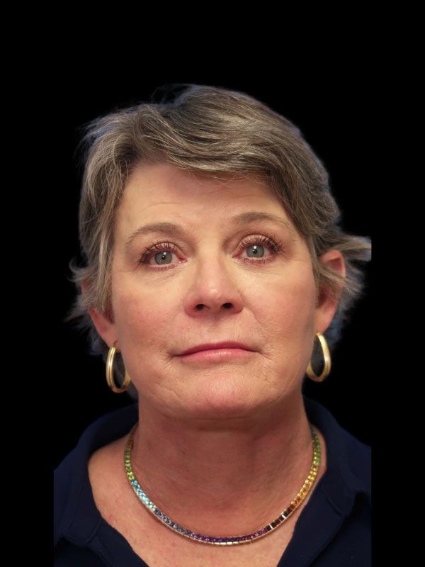 Endoscopic Browlift Gallery Before & After