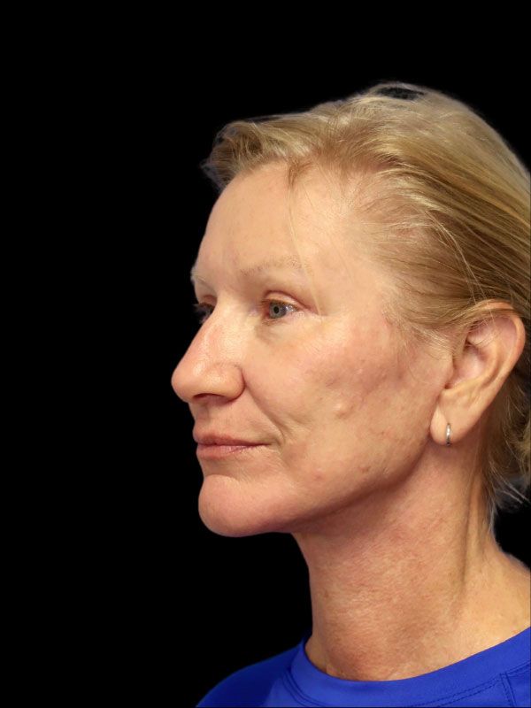 Endoscopic Browlift Gallery Before & After