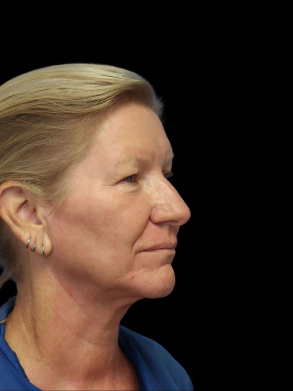 Endoscopic Browlift Gallery Before & After