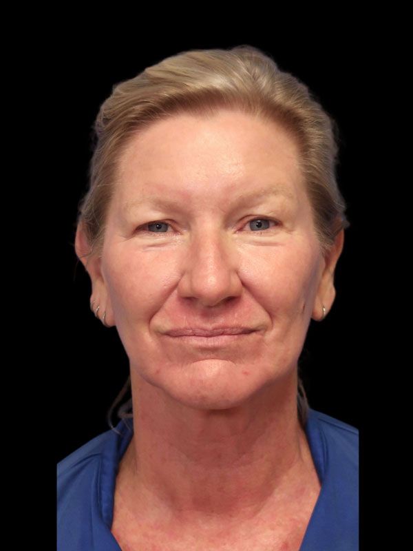 Endoscopic Browlift Gallery Before & After