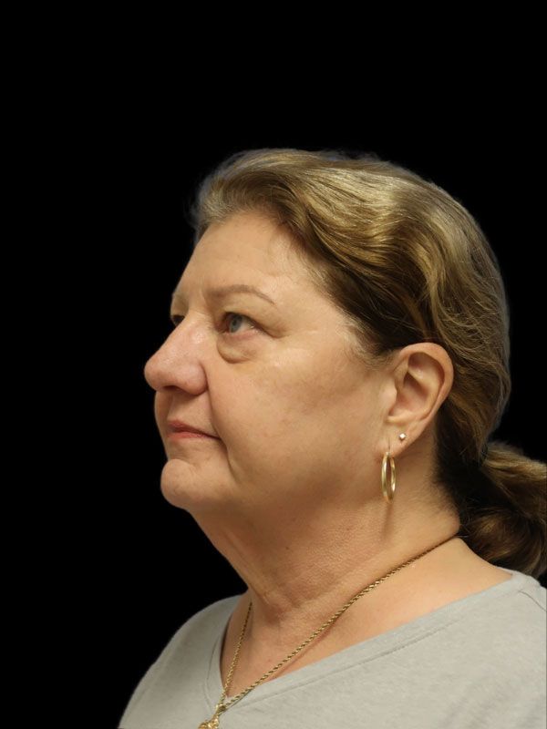 Endoscopic Browlift Gallery Before & After