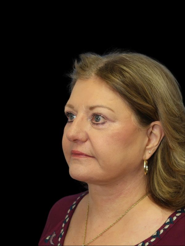 Endoscopic Browlift Gallery Before & After