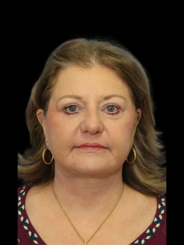 Endoscopic Browlift Gallery Before & After