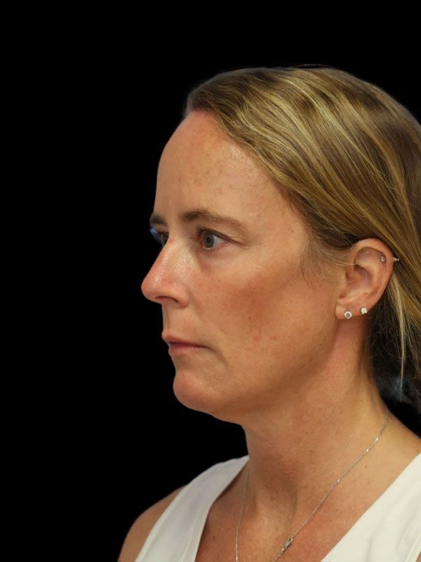 Endoscopic Browlift Gallery Before & After