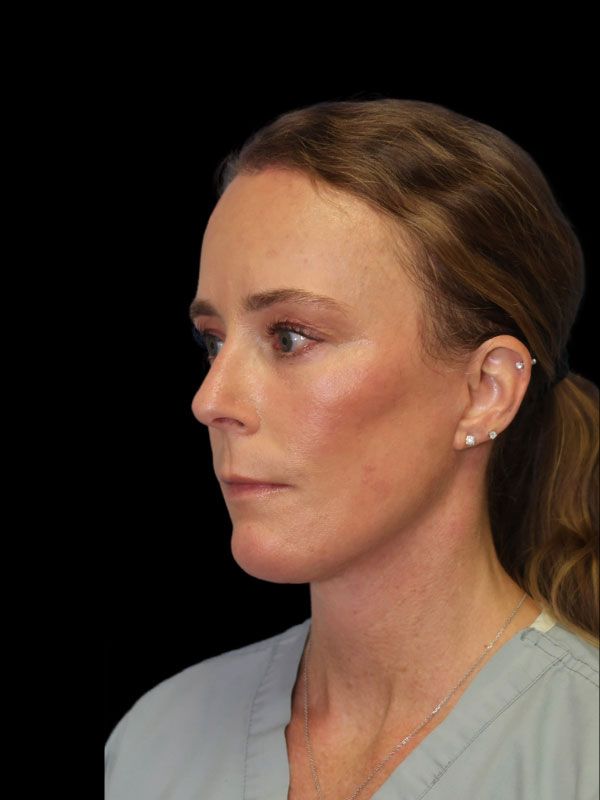 Endoscopic Browlift Gallery Before & After