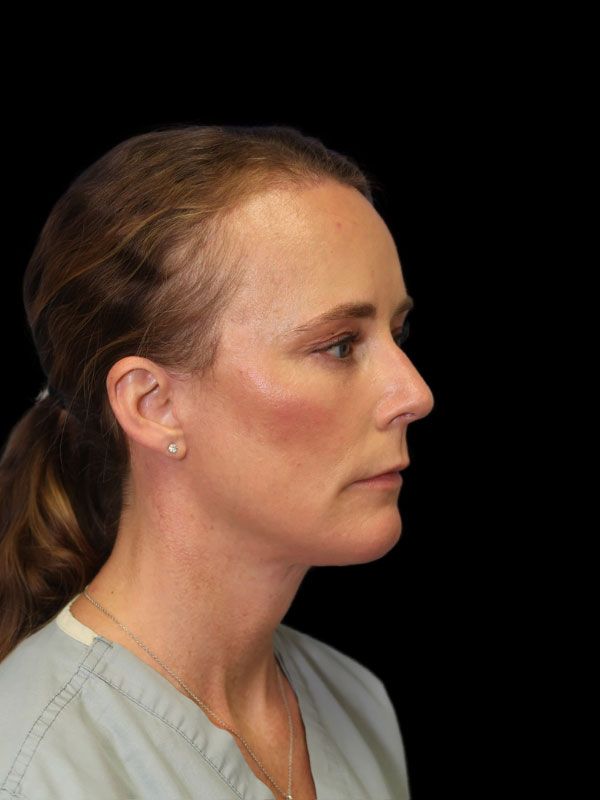 Endoscopic Browlift Gallery Before & After