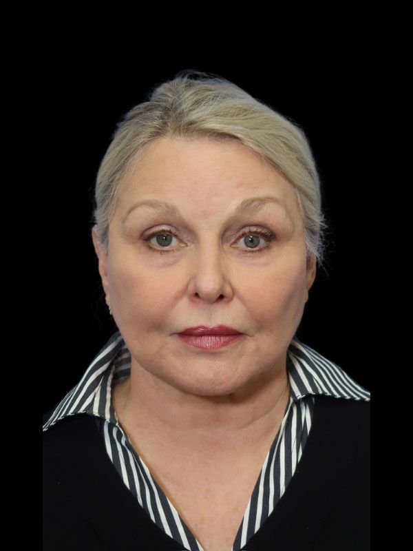 Endoscopic Browlift Gallery Before & After