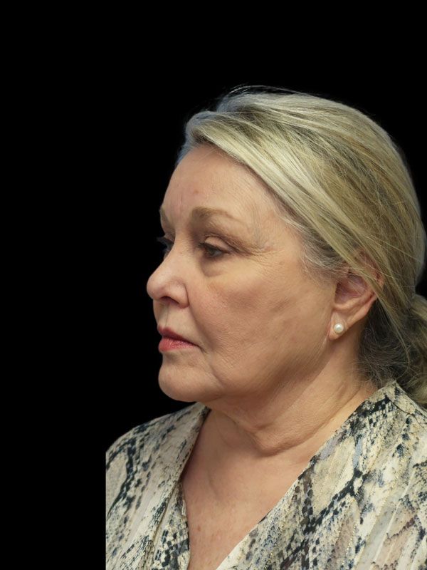 Endoscopic Browlift Gallery Before & After