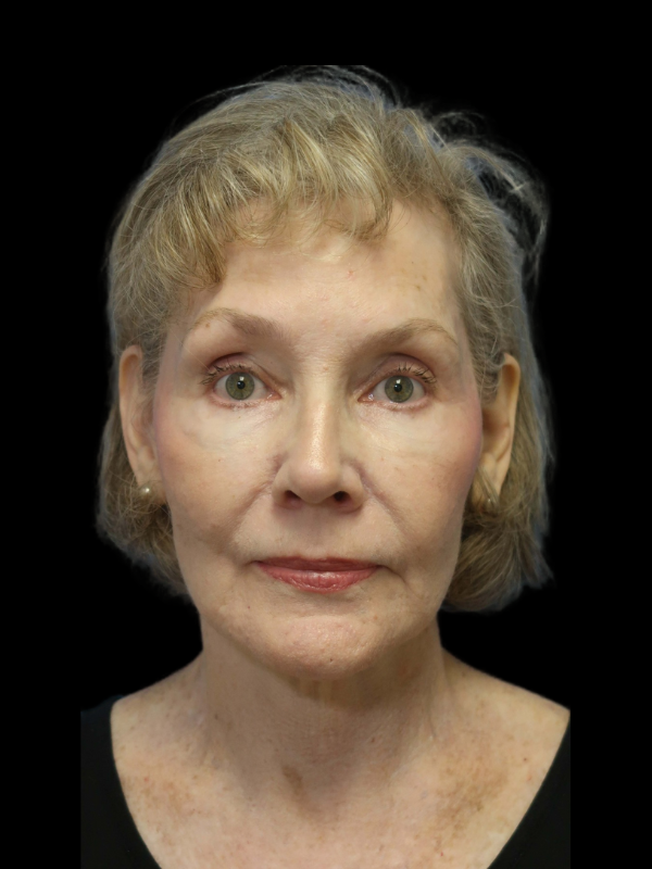 Endoscopic Browlift Gallery Before & After