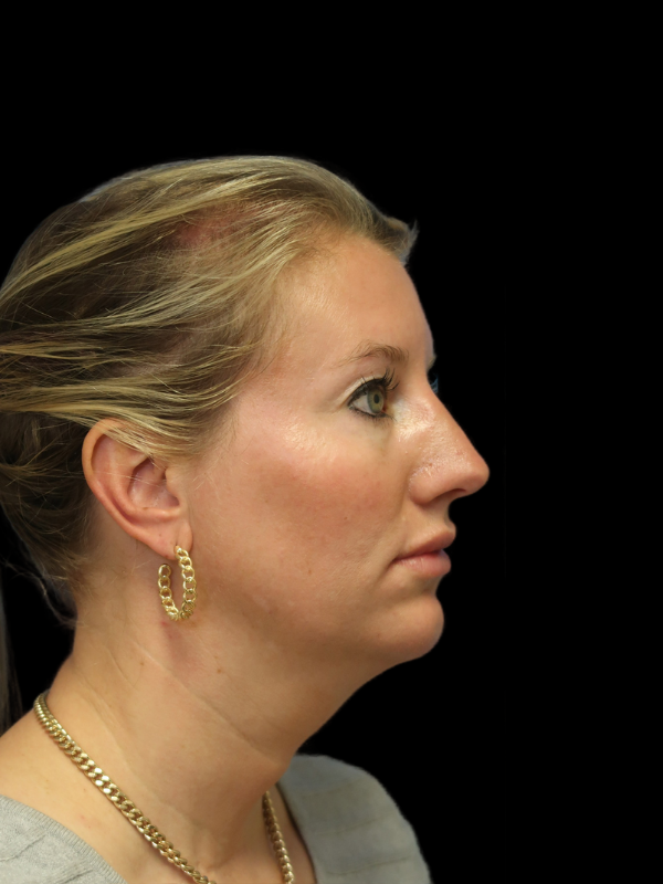 Endoscopic Browlift Gallery Before & After