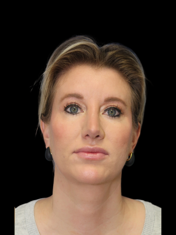 Endoscopic Browlift Gallery Before & After