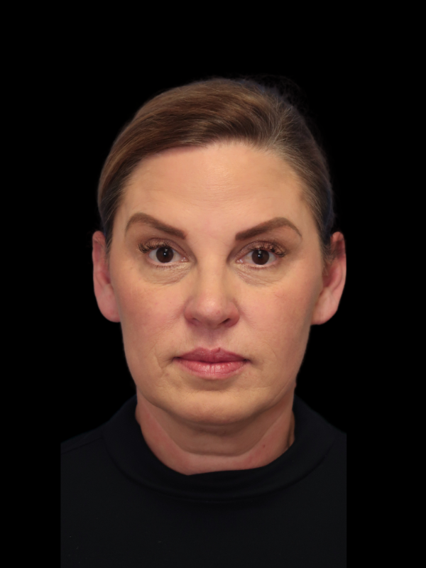 Endoscopic Browlift Gallery Before & After