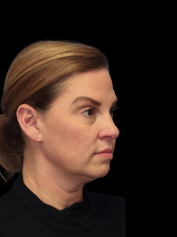 Endoscopic Browlift Gallery Before & After