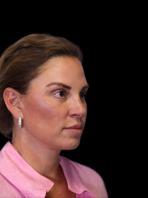 Endoscopic Browlift Gallery Before & After