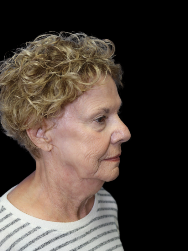 Endoscopic Browlift Gallery Before & After