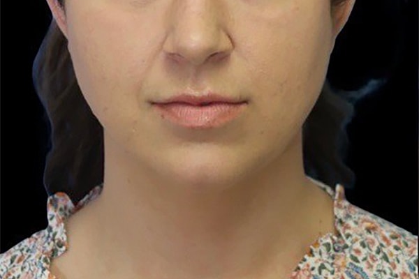 Buccal Fat Removal Before & After