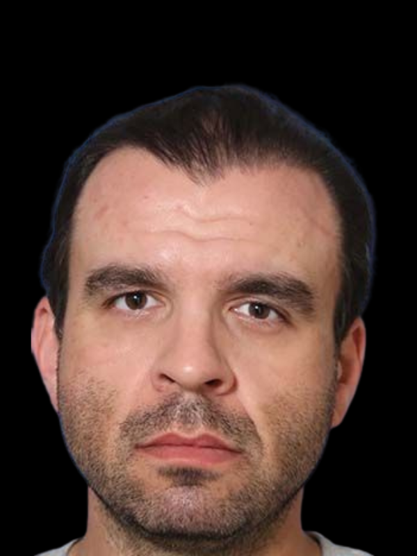 Buccal Fat Removal Before & After