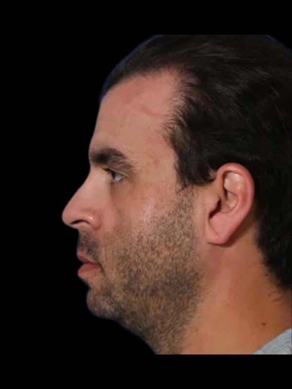 Buccal Fat Removal Before & After