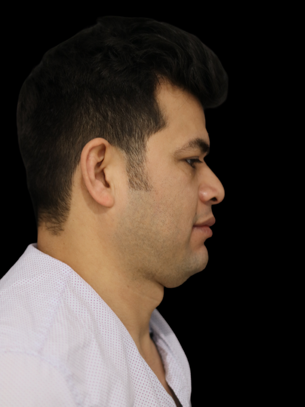 Buccal Fat Removal Before & After