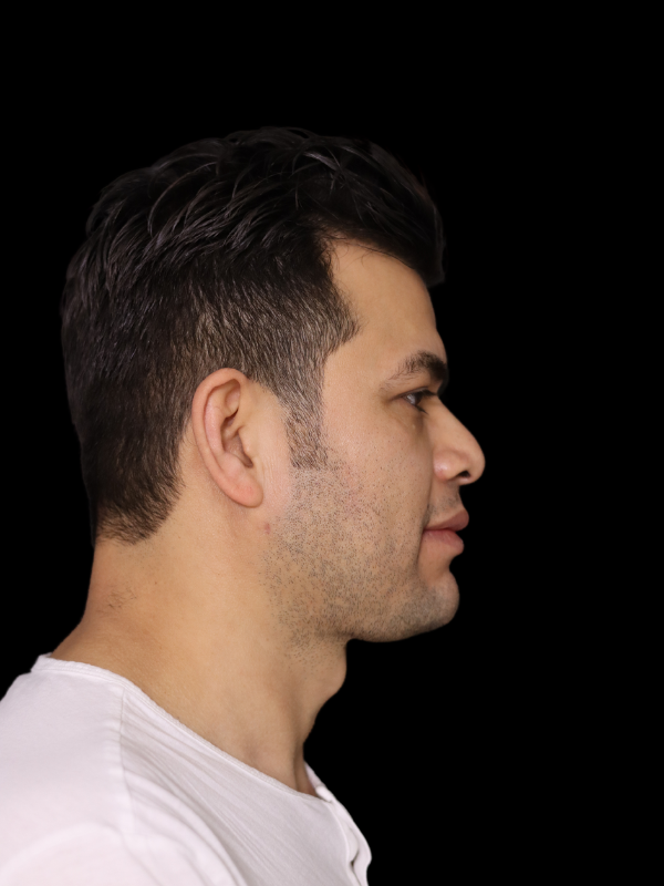 Buccal Fat Removal Before & After