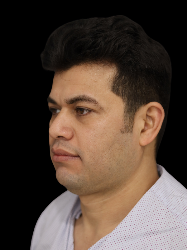 Buccal Fat Removal Before & After