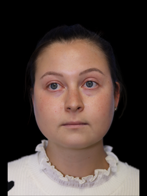 Buccal Fat Removal Before & After