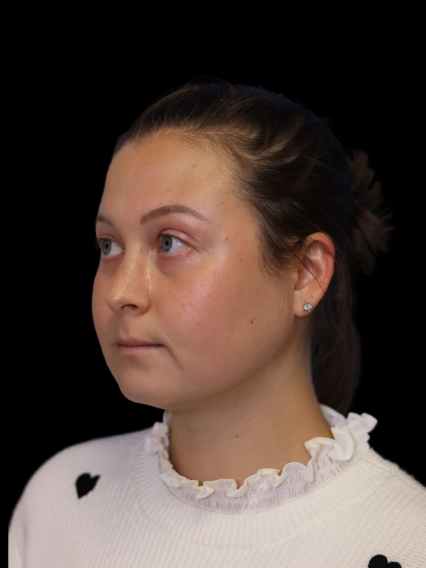 Buccal Fat Removal Before & After