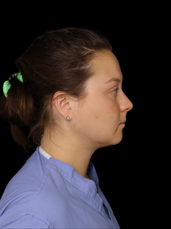 Buccal Fat Removal Before & After