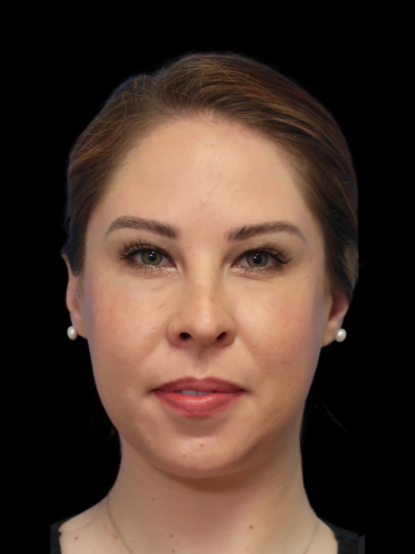 Buccal Fat Removal Before & After