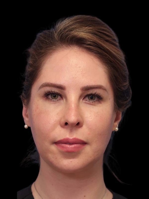 Buccal Fat Removal Before & After