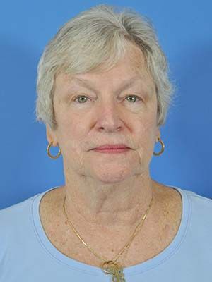 Reconstruction Before & After