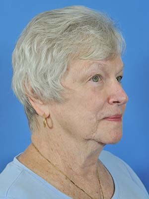 Reconstruction Before & After