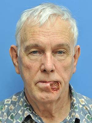 Reconstruction Before & After