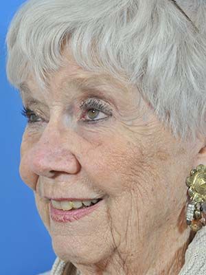 Reconstruction Before & After