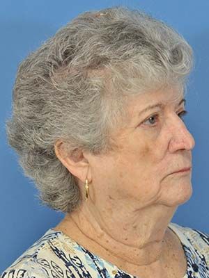 Reconstruction Before & After