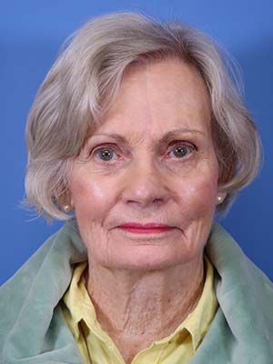 Reconstruction Before & After